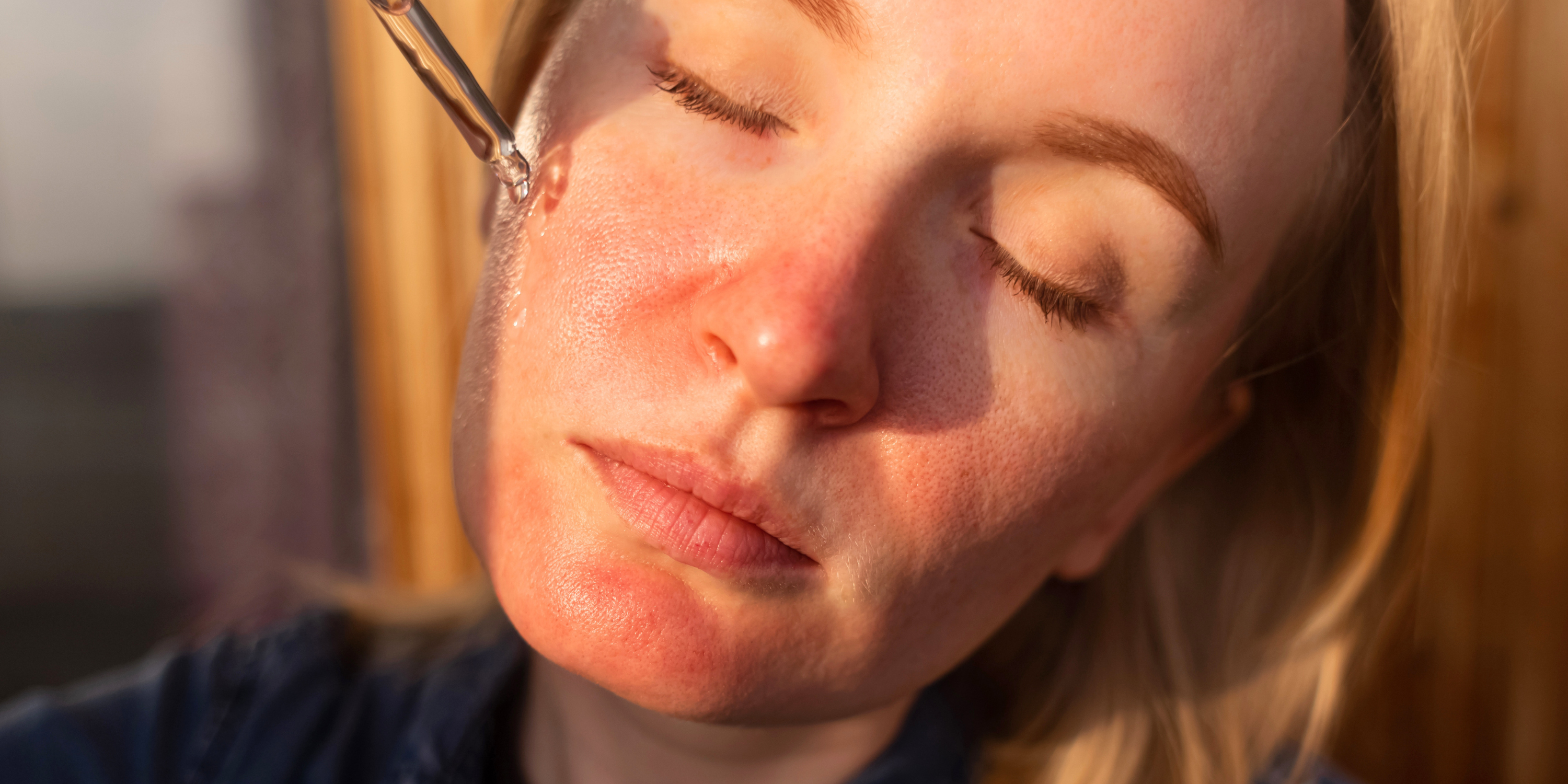 Rosacea: Causes, Triggers & How to Calm Sensitive Skin Naturally